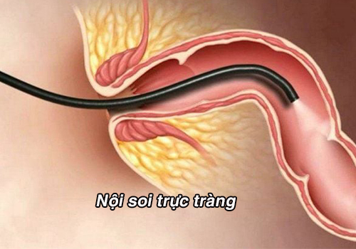 Nội soi trực tràng: Quy trình và những lưu ý khi thực hiện