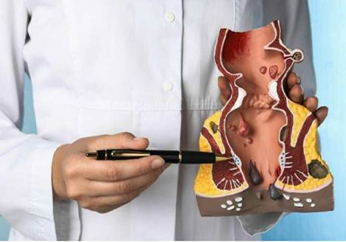 Phân biệt trĩ nội trĩ ngoại và các dấu hiệu nhận biết