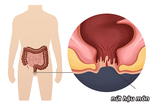 Bị nứt hậu môn có tự khỏi không? Bác sĩ chuyên khoa giải đáp