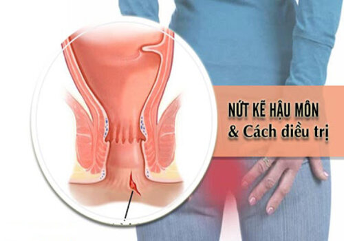 Đi đại tiện ra máu có nguy hiểm không? Đây là dấu hiệu bệnh lý gì?