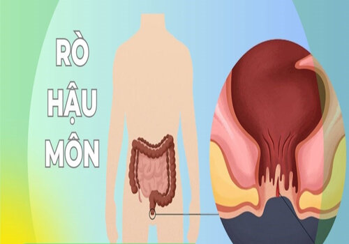 Rò hậu môn là bệnh gì và có thể gây biến chứng nguy hiểm nào?