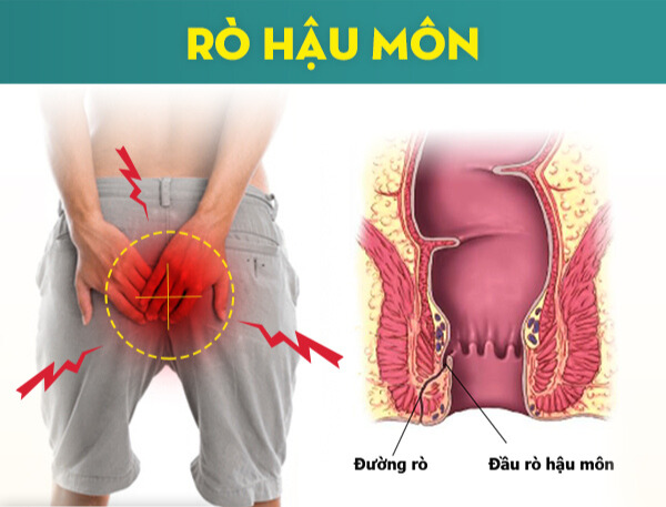 Rò hậu môn có nguy hiểm không? Lắng nghe tư vấn từ bác sĩ chuyên khoa