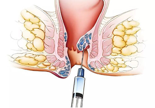 Tiêm xơ trĩ – Phương pháp chữa trĩ hiệu quả không cần phẫu thuật