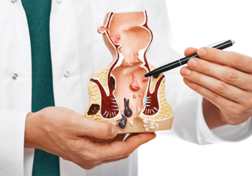 Khám trĩ là khám những gì? Những lưu ý trước khi đi khám trĩ