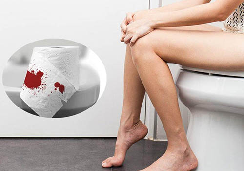 Đi ỉa ra máu tươi cảnh báo bệnh gì? Bác sĩ chuyên khoa chia sẻ
