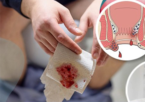 Đi nặng ra máu tươi cảnh báo bệnh gì? Xử trí ra sao