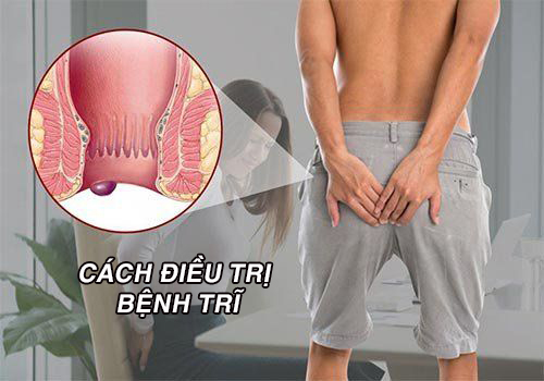 Cách điều trị bệnh trĩ hiệu quả – Lắng nghe giải đáp của bác sĩ chuyên khoa
