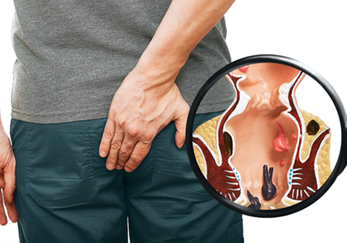 Nguyên nhân bệnh trĩ là gì? Phòng ngừa bằng cách nào?
