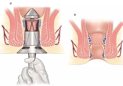 Phương pháp cắt trĩ không đau đang được áp dụng hiện nay