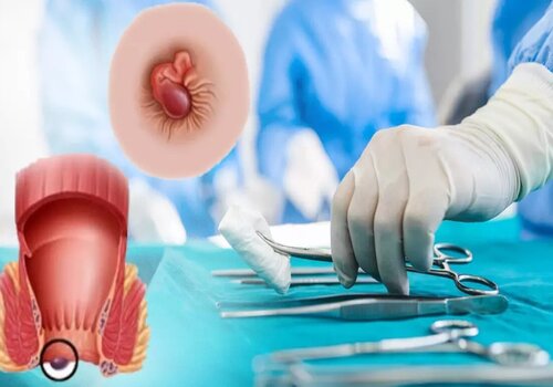 Phẫu thuật cắt trĩ có phải nằm viện không?