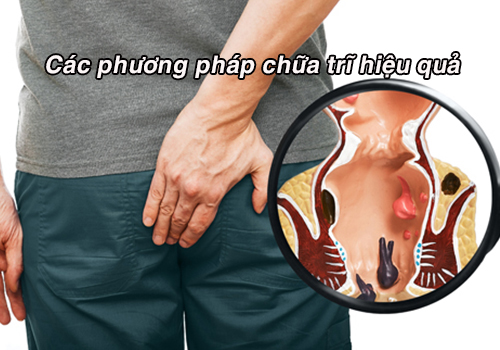 Các cách chữa bệnh trĩ hiệu quả và an toàn chuẩn y khoa