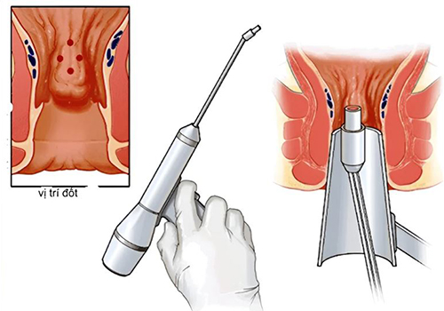 Phương pháp điều trị bệnh trĩ hiệu quả – Thoát khỏi nỗi ám ảnh bệnh trĩ