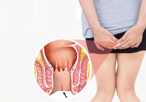 Những triệu chứng nhận biết sớm bệnh nứt kẽ hậu môn
