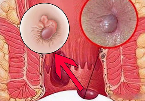 Búi trĩ sưng to cần xử lý như thế nào?