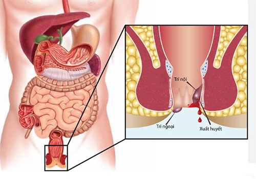 Tìm hiểu ngay bệnh trĩ trước khi quá muộn – Đâu là cách điều trị hiệu quả?